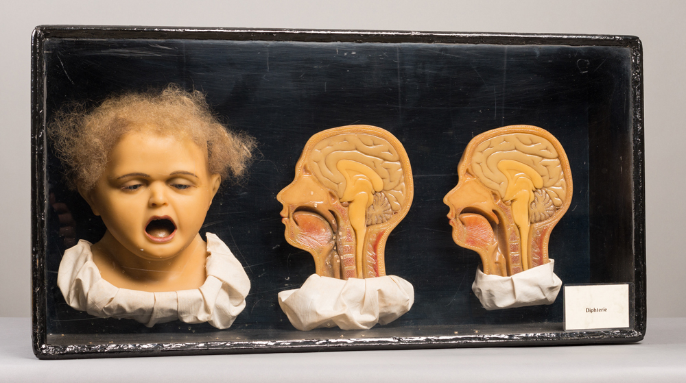 Wax model of child with diphtheria